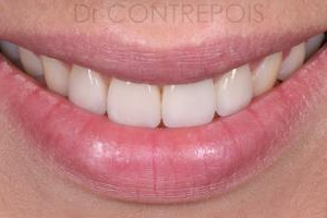 IMPLANT
