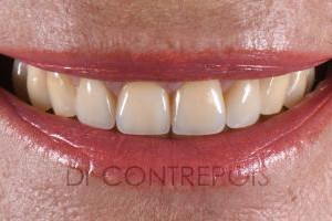 implant unitaire