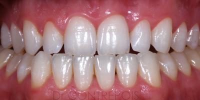 IMPLANT