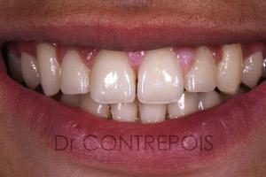 implant unitaire