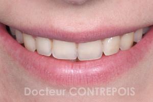 IMPLANT