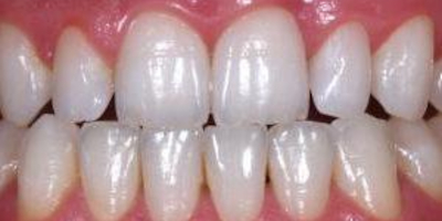 IMPLANT