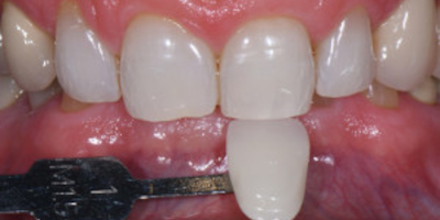 implant unitaire