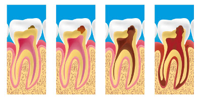 Traitements dû aux caries à Bordeaux