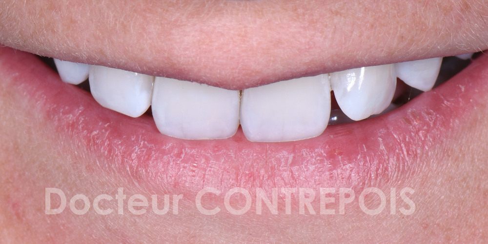 Dentiste Bordeaux Eclaircissement dentaire