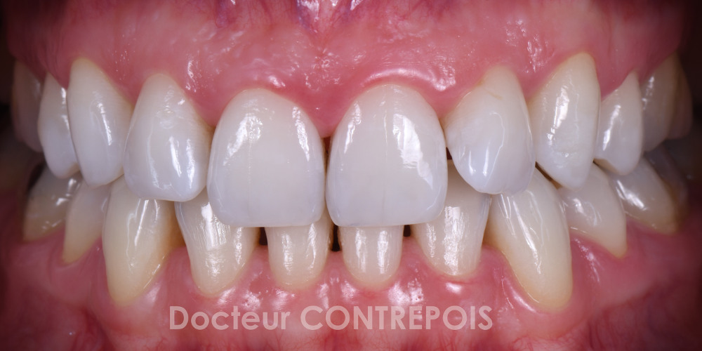 Dentiste Bordeaux Blanchiment des dents