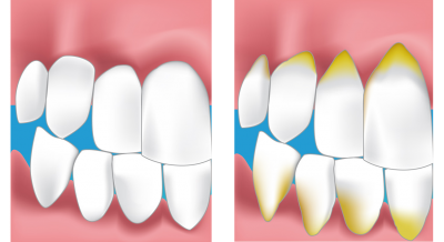 Soins des gencives, dentiste parodontie Bordeaux